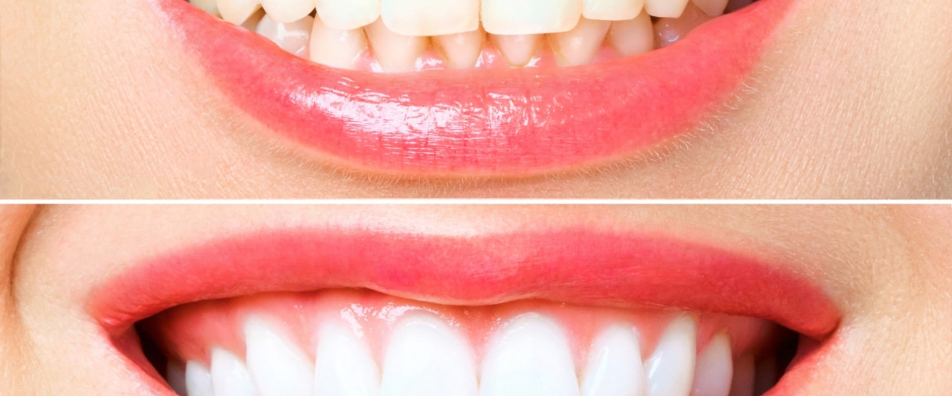 Discover the Teeth Whitening Best Method: Achieve a Gleaming Grin in No Time!