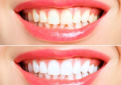 Discover the Teeth Whitening Best Method: Achieve a Gleaming Grin in No Time!